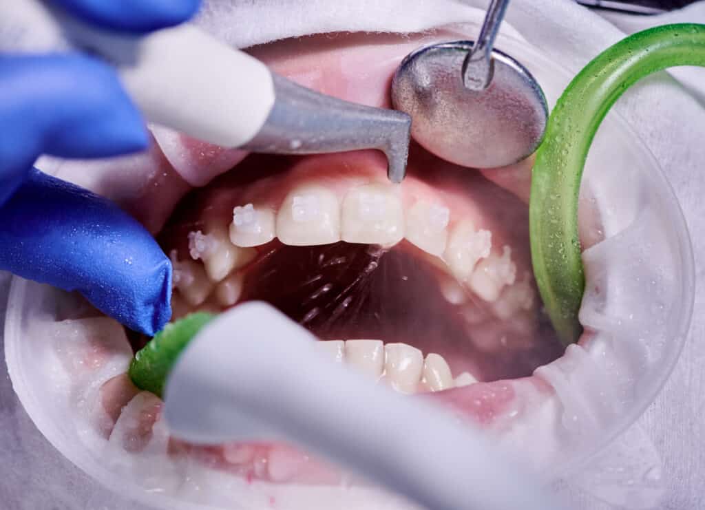 Wat doet een mondhygiënist allemaal?